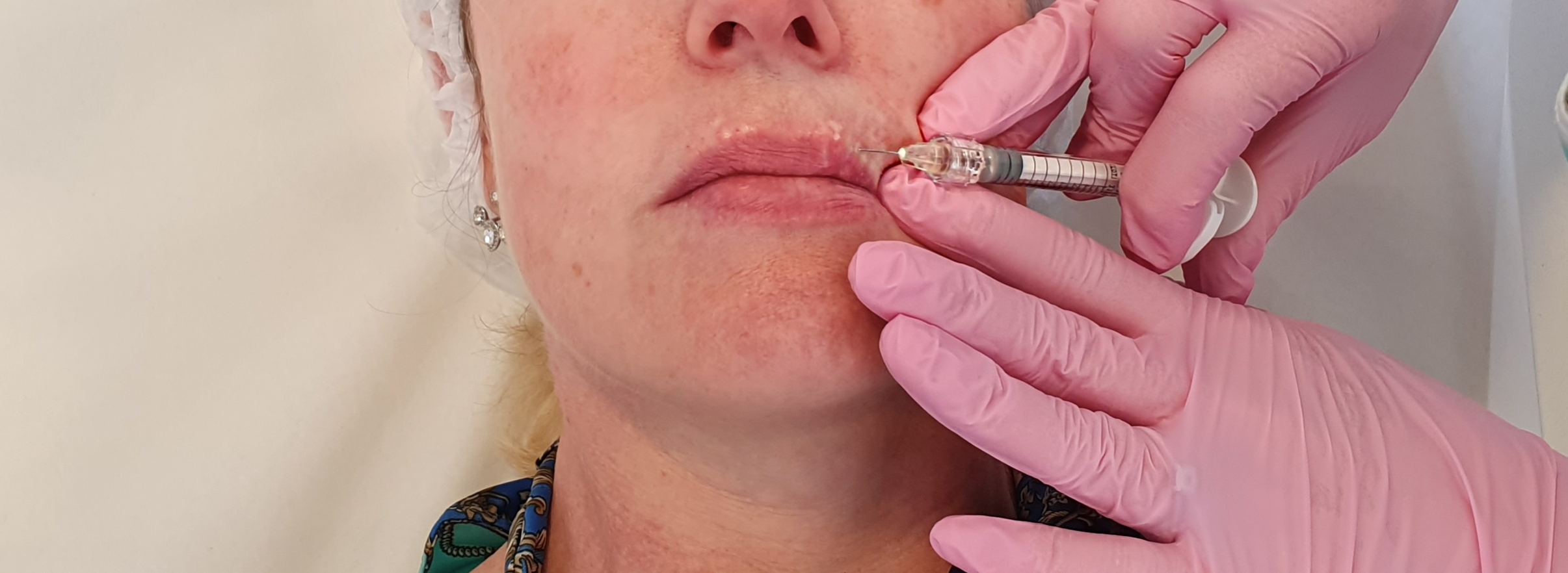 Injections acide hyaluronique
